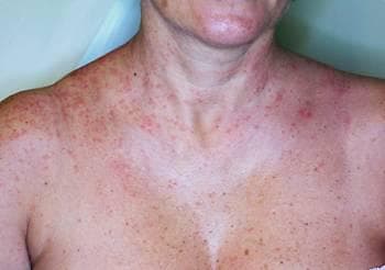 processionaria eritema immagini